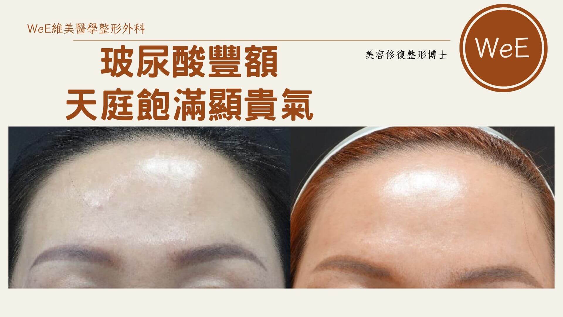 有哪些豐額材質與技術考量?WeE 不用動刀即可貴氣逼人