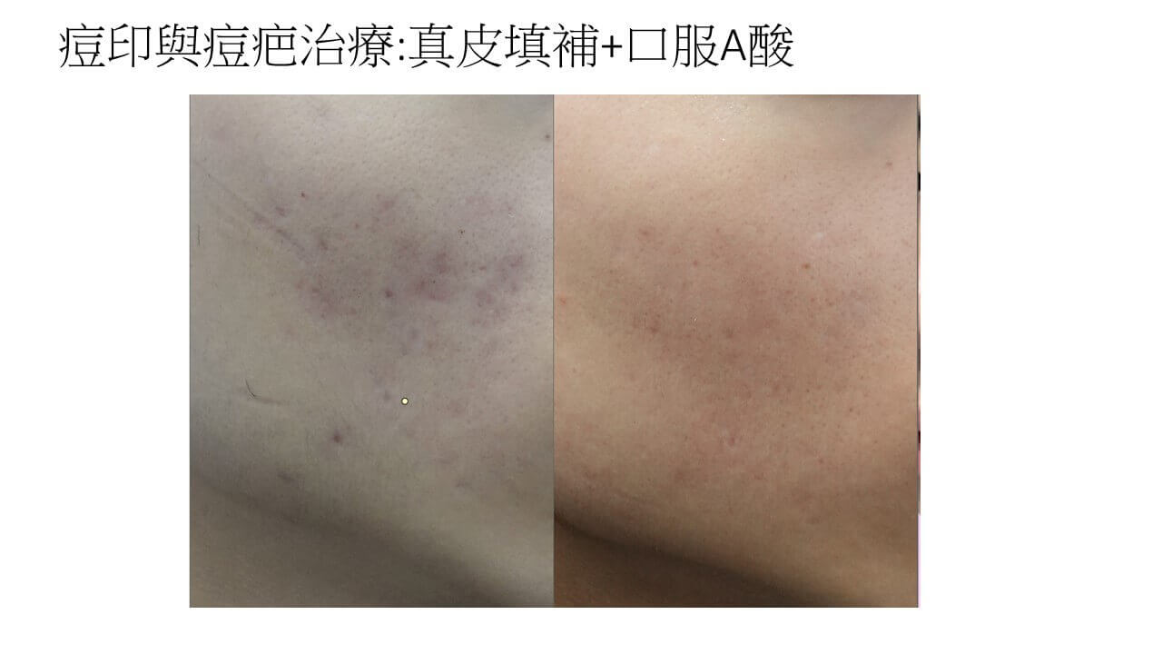 痘印與痘疤的差異:平面色素沉澱 vs 凹凸真皮結構缺損