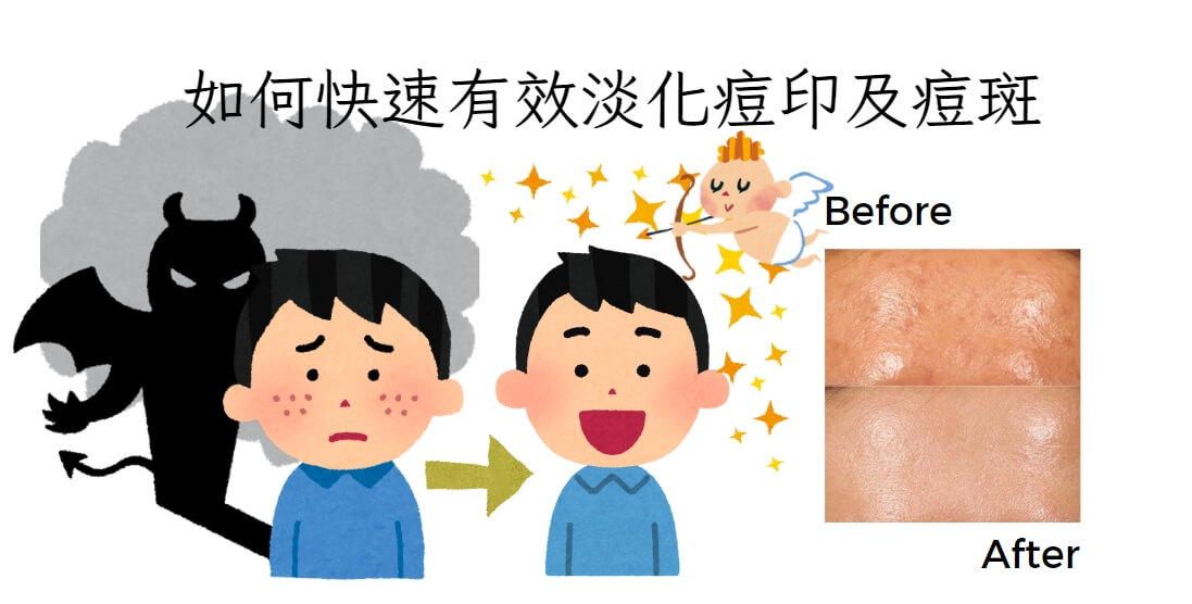 痘斑痘印雷射改善:IPL、長脈衝 1064nm 與皮秒雷射的分工
