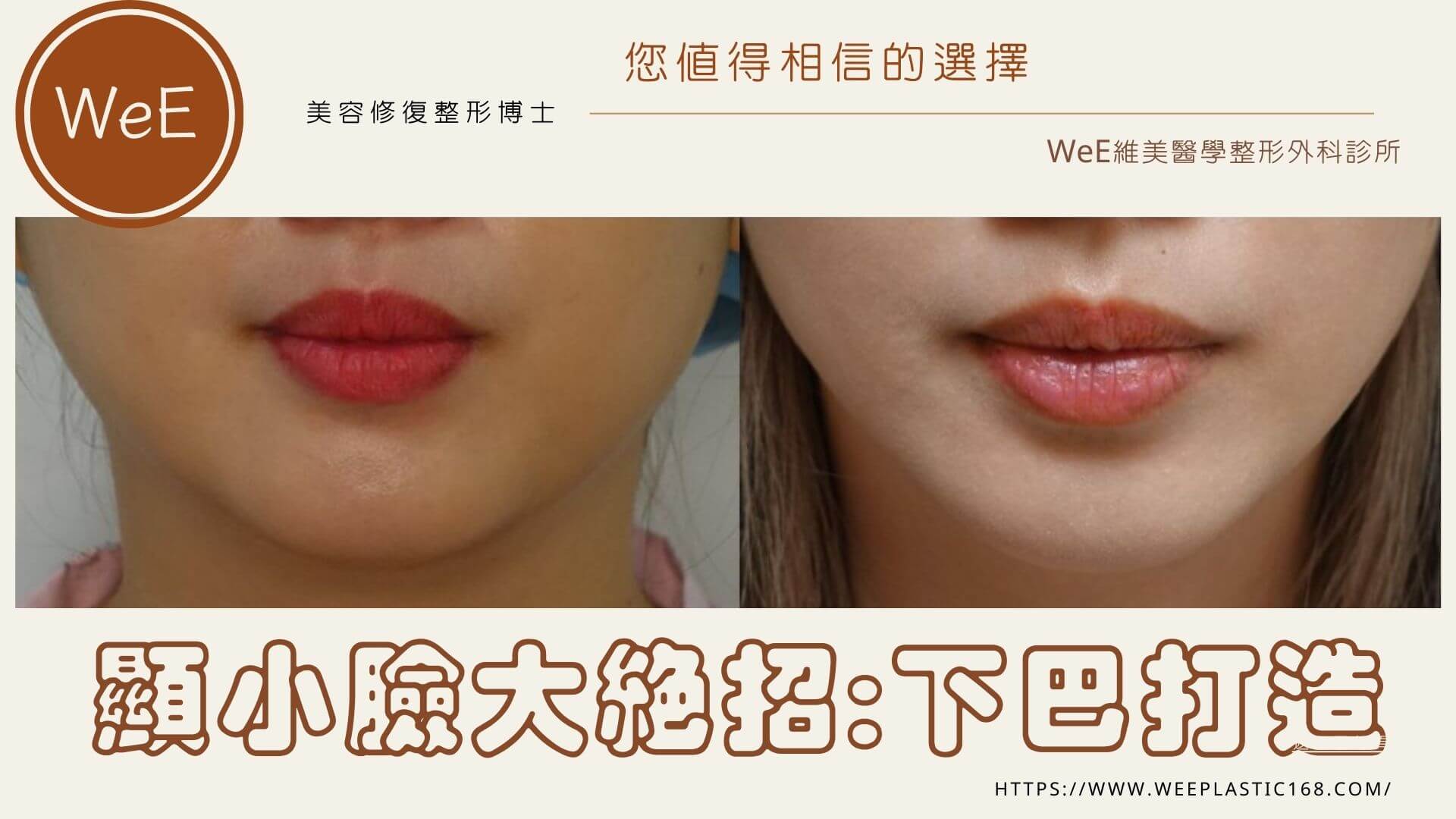 墊下巴怎麼挑?玻尿酸vs假體