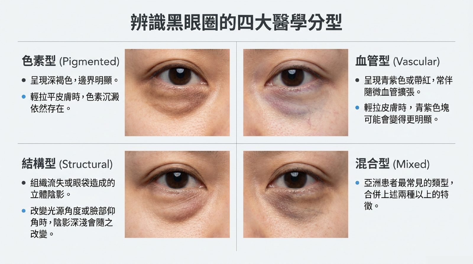 黑眼圈四大醫學分型實例:色素型(深褐、邊界明顯)、血管型(青紫或帶紅)、結構型(淚溝眼袋立體陰影)、混合型(亞洲最常見)的眼周外觀比較