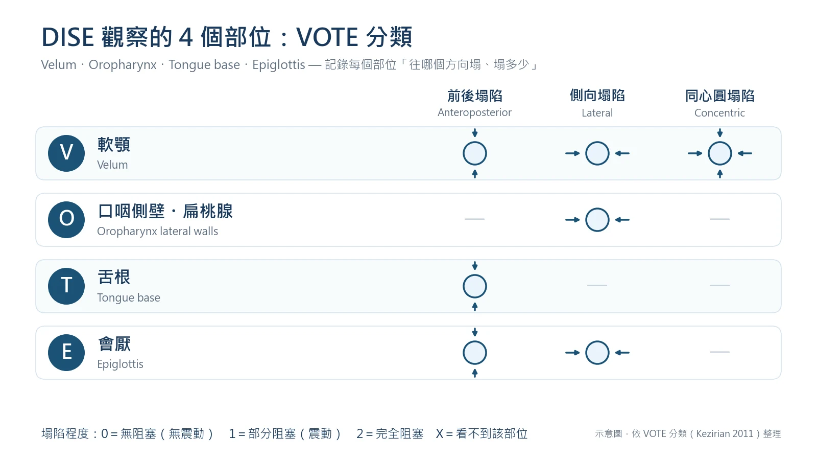 DISE 的 VOTE 分類示意圖:軟顎可能前後、側向或同心圓塌陷;口咽側壁為側向塌陷;舌根為前後塌陷;會厭為前後或側向塌陷;程度分 0、1、2 與 X