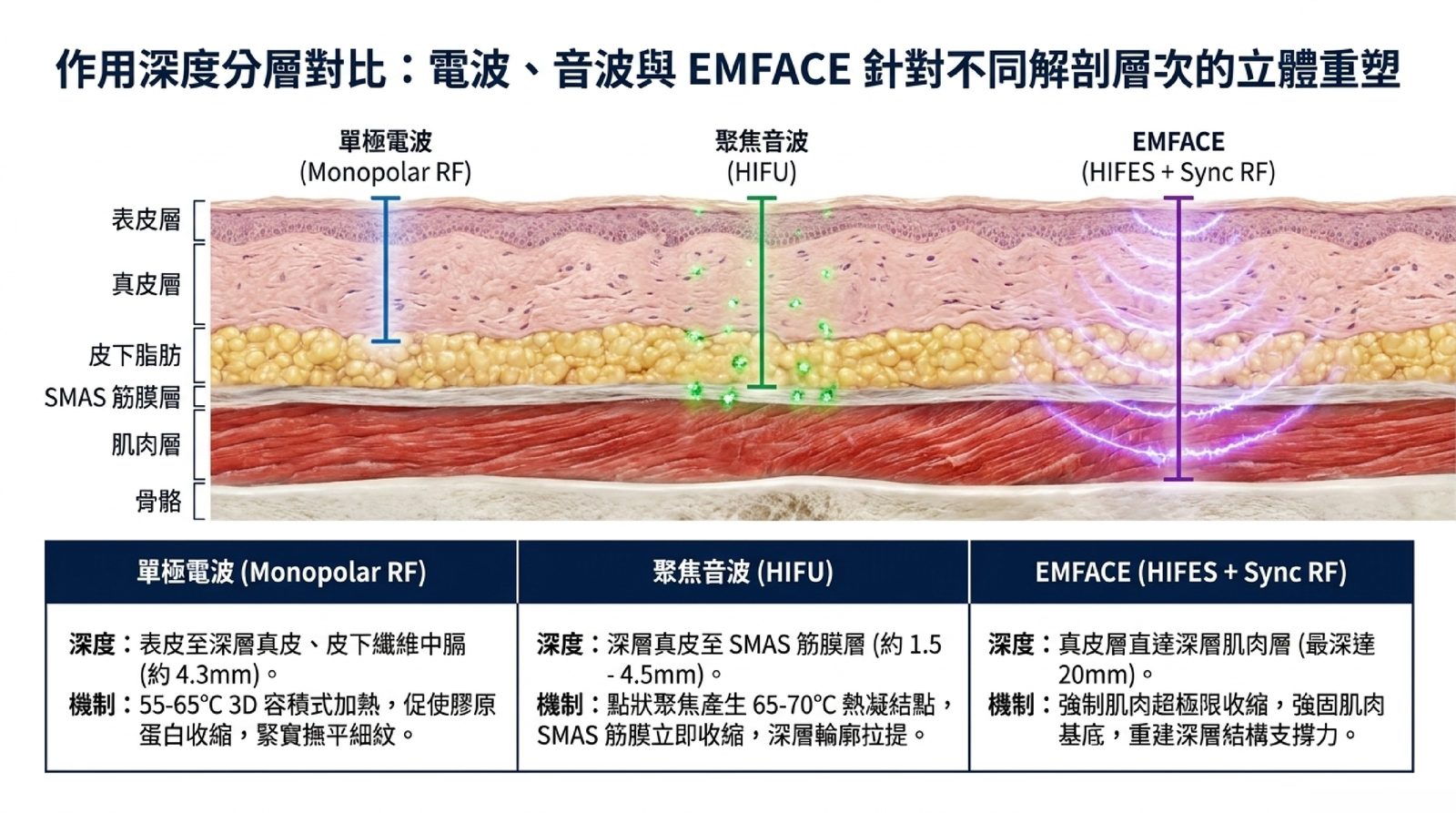 單極電波、聚焦音波 HIFU 與 EMFACE 作用深度分層對比示意:從表皮、真皮、皮下脂肪、SMAS 筋膜層到肌肉層的能量到達範圍