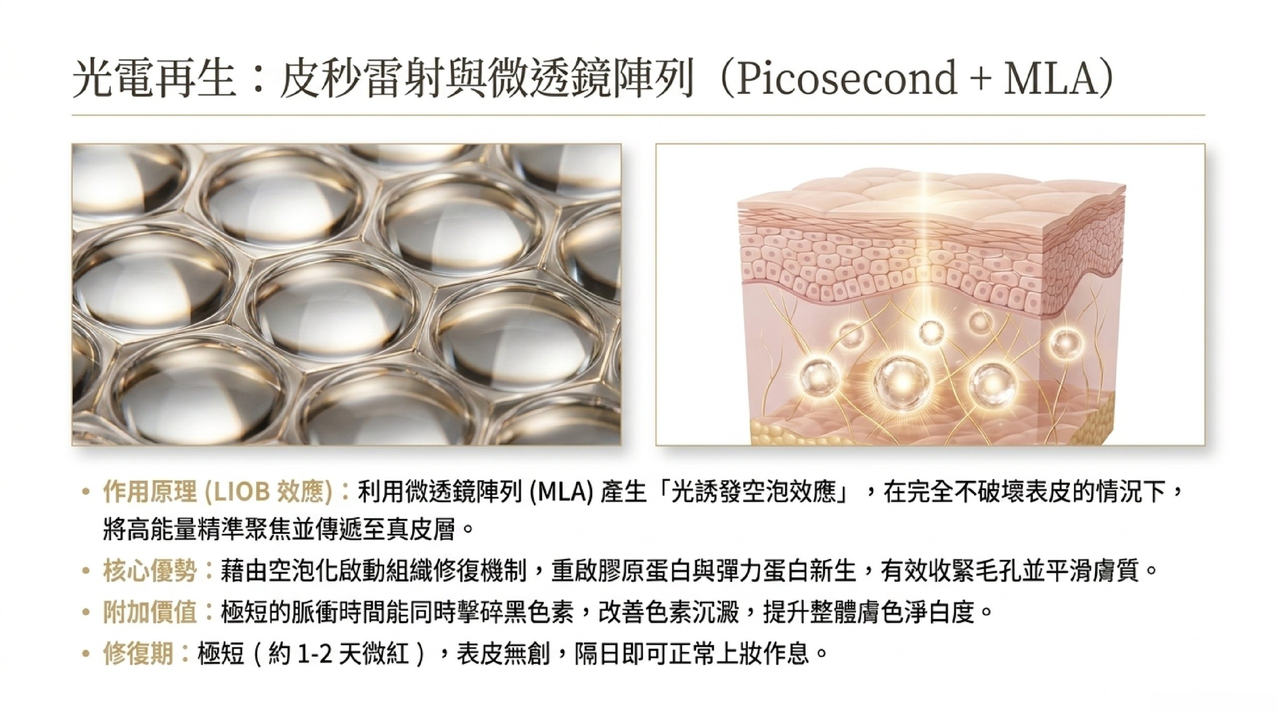 皮秒雷射搭配微透鏡陣列 MLA:LIOB 空泡效應誘導真皮膠原新生收縮毛孔
