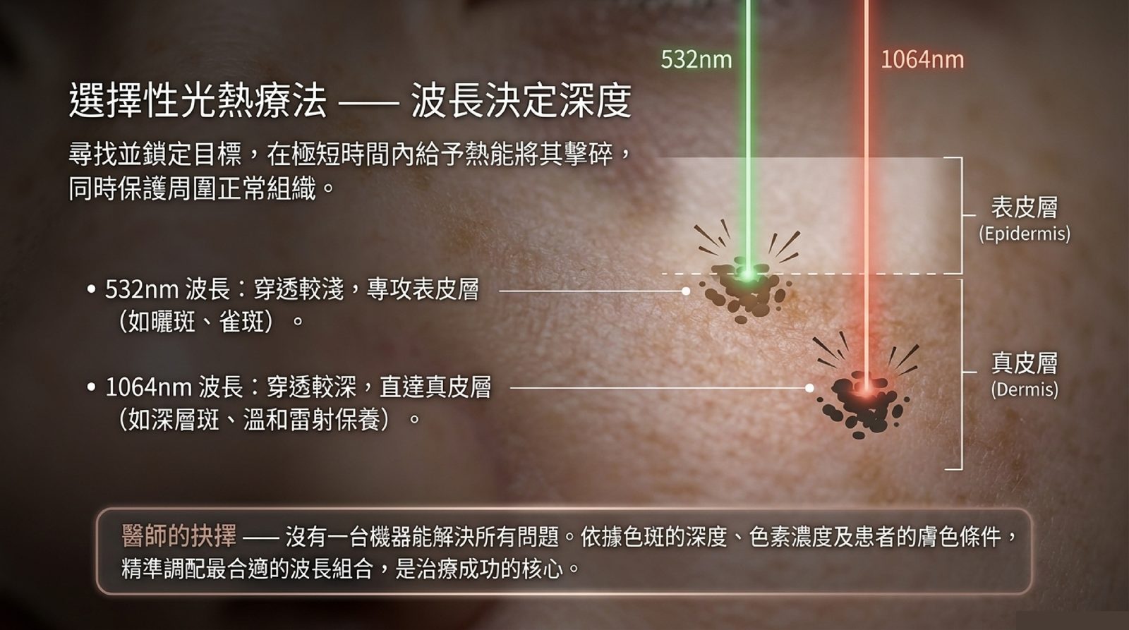 選擇性光熱分解示意:532nm 波長作用於表皮層曬斑,1064nm 波長穿透至真皮層處理深層斑