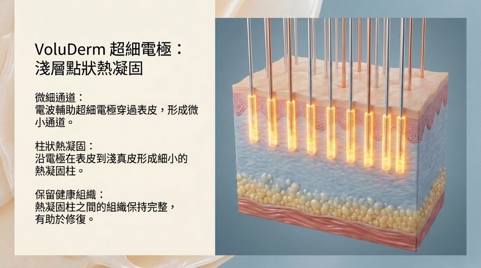 VoluDerm 超細電極:電波輔助穿過表皮,沿電極在表皮到淺真皮形成細小熱凝固柱,柱間保留健康組織