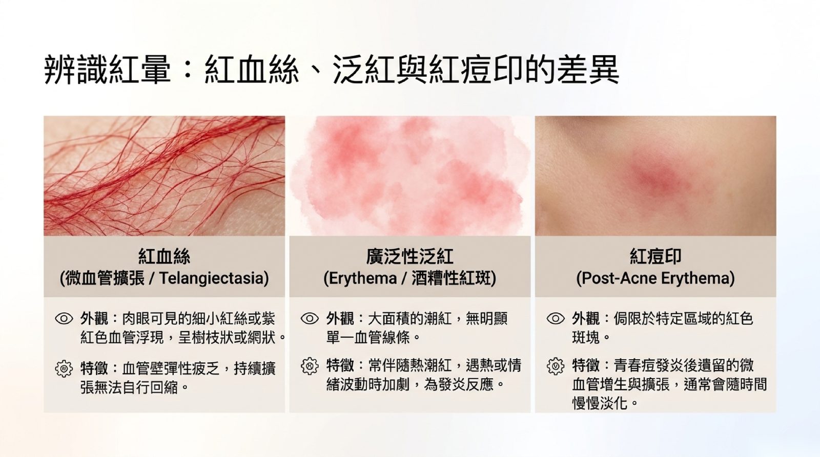 辨識臉部紅色問題:紅血絲是可見的細小紅絲或紫紅色血管,廣泛性泛紅是大面積潮紅,紅痘印侷限在發炎過的位置並會慢慢淡化