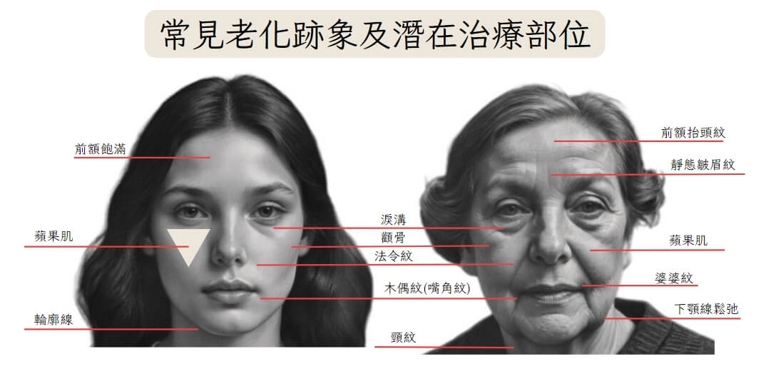 常見老化跡象與 Q+ 音波拉提的潛在治療部位:抬頭紋、法令紋、雙下巴、頸部鬆弛