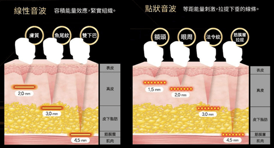 Q+ 音波拉提點狀與線狀探頭比較:線性緊實與點狀拉提的差異
