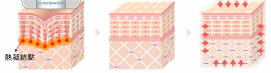 海芙音波作用深度剖面:能量聚焦於真皮層、SMAS 筋膜層與脂肪層