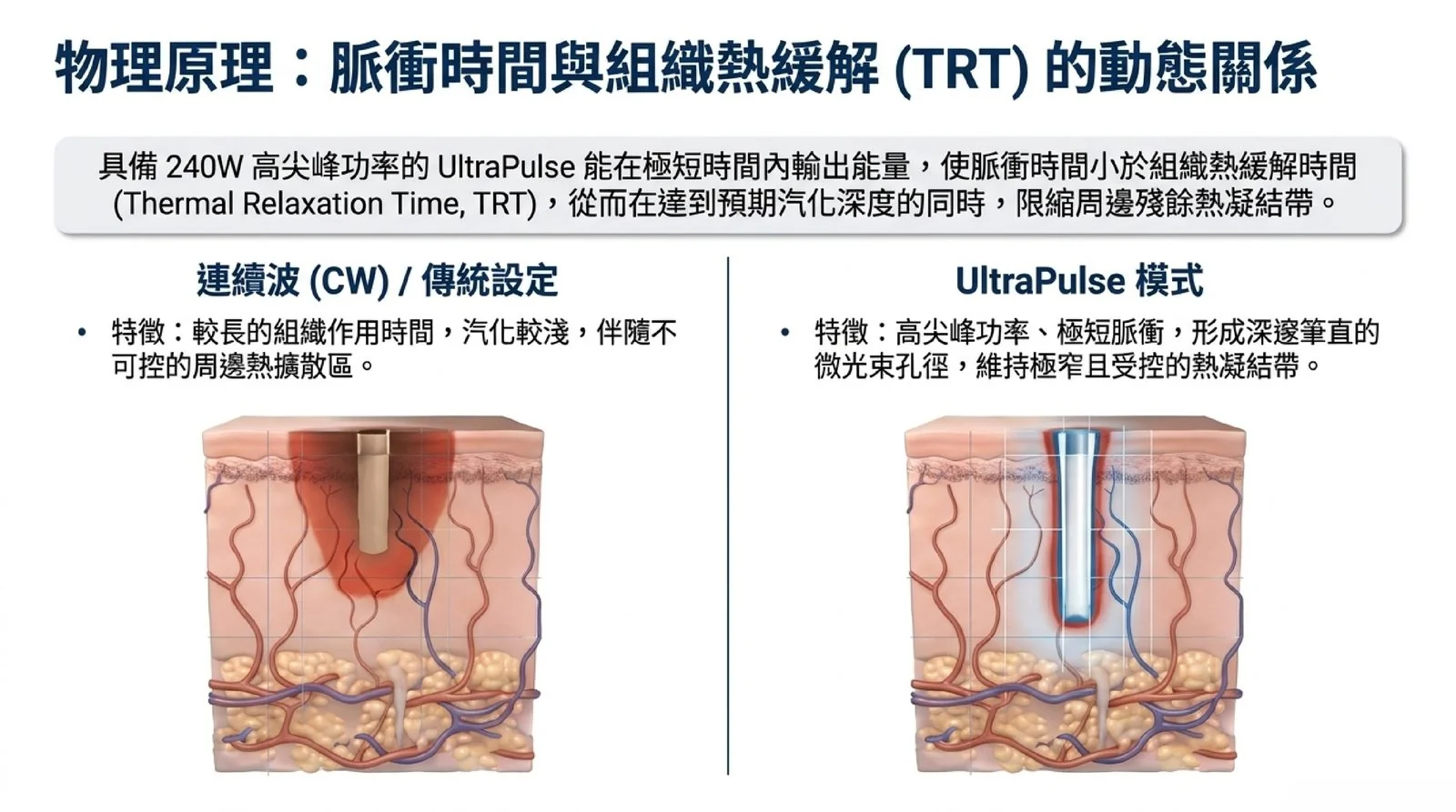 UltraPulse 超脈衝模式與連續波雷射在脈衝時間、汽化深度與周邊熱擴散區的比較示意