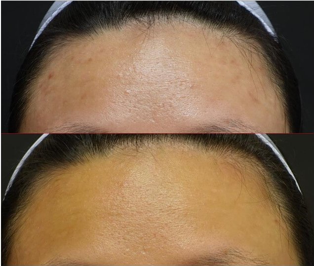 黑色痘印及痘斑色素