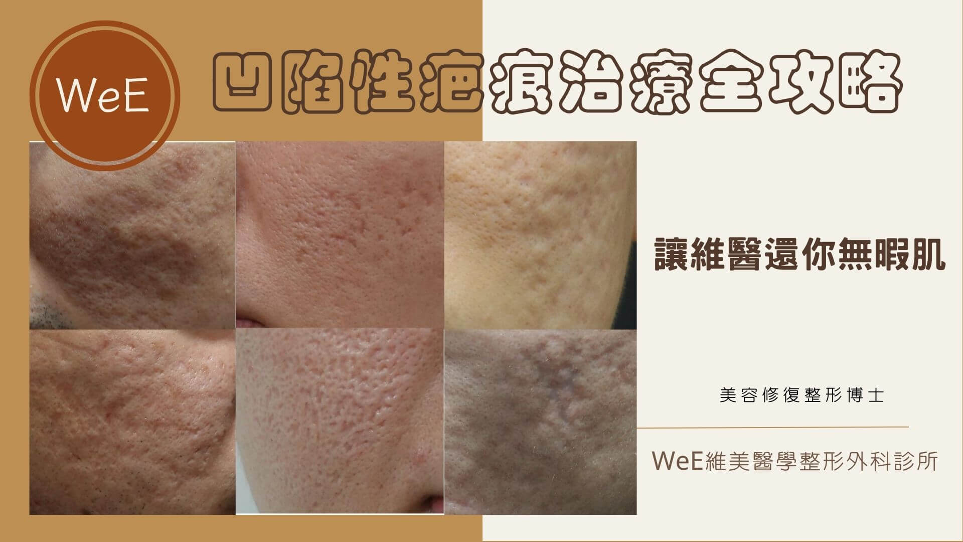 青春痘疤治療工具大比較：那些治療組合有效？低成本治療方式- WeE