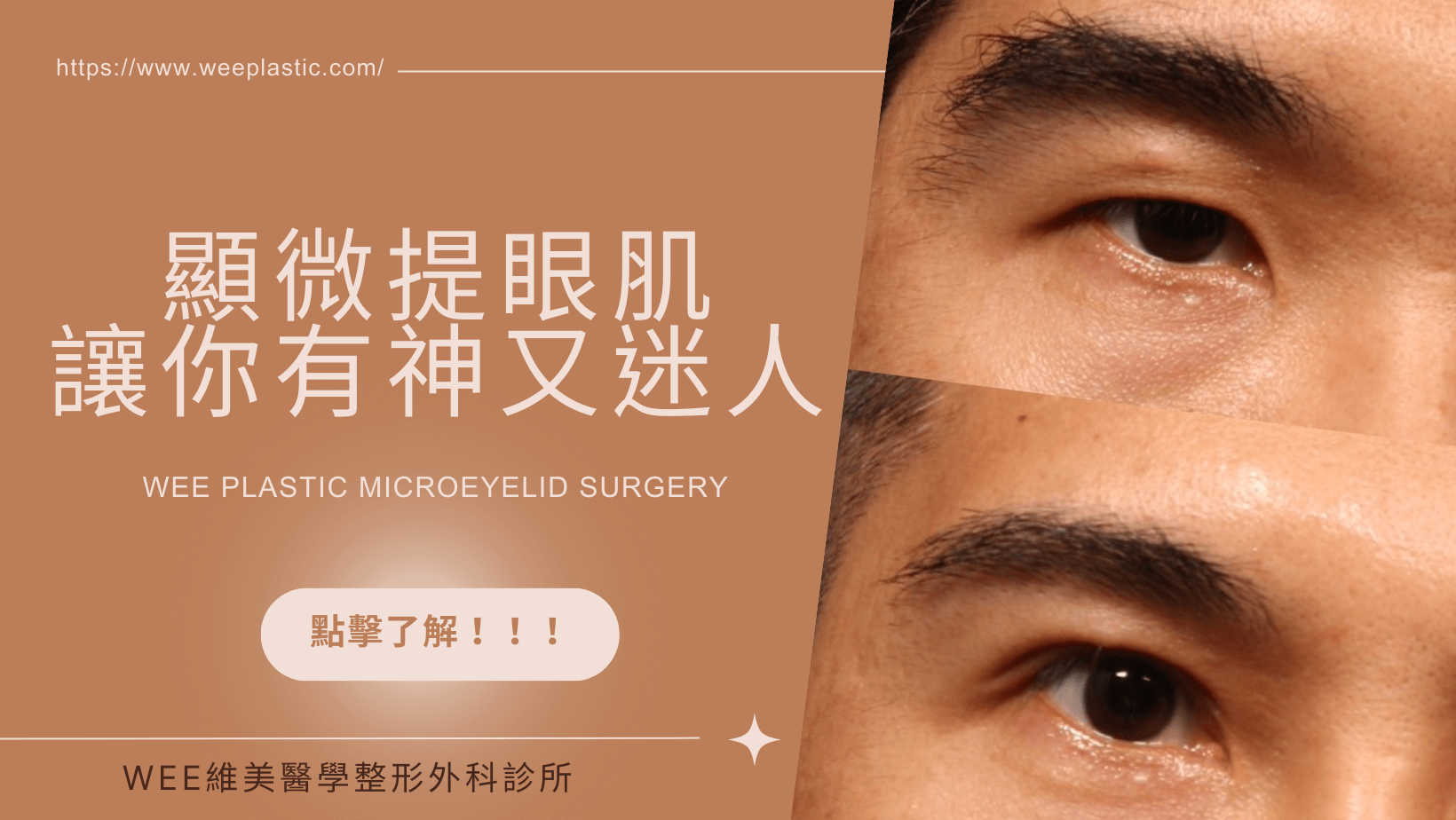 如何改善重度眼瞼下垂 ? 聯合懸吊法