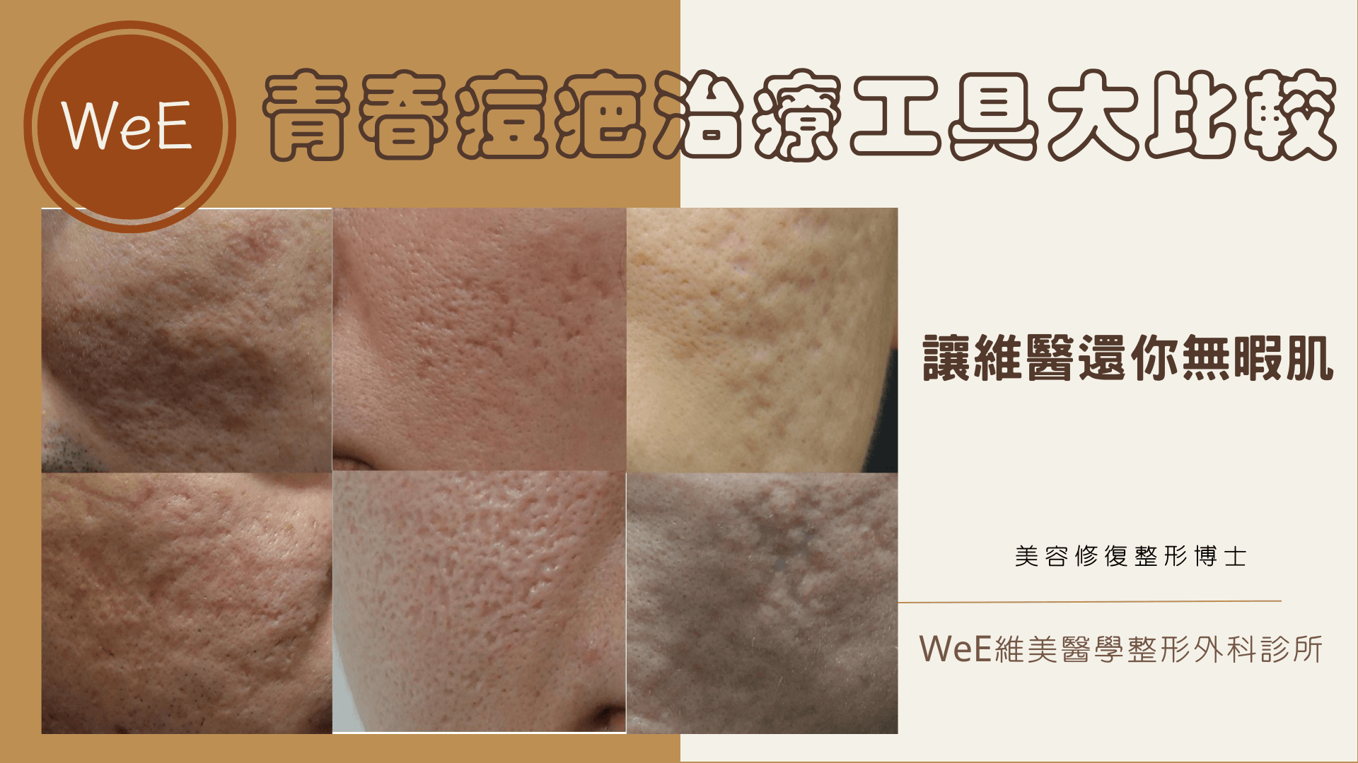 青春痘疤治療工具大比較：那些治療組合有效？低成本治療方式