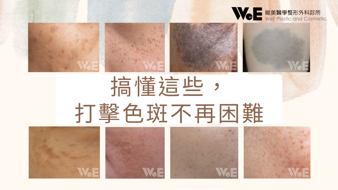 搞懂這些，打擊色斑不再困難