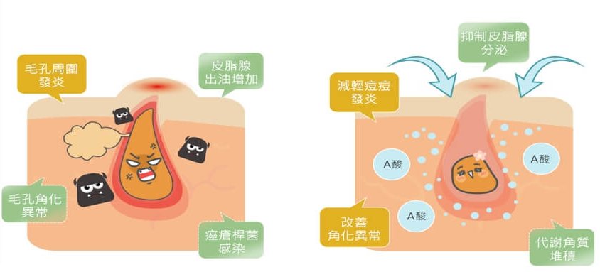 青春痘治療方法示意圖
