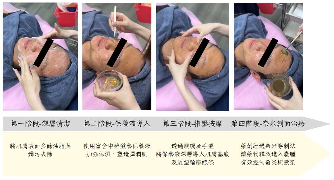青春痘治療設備