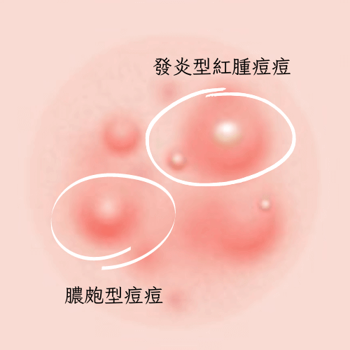 青春痘發炎型紅腫.膿皰型痘痘