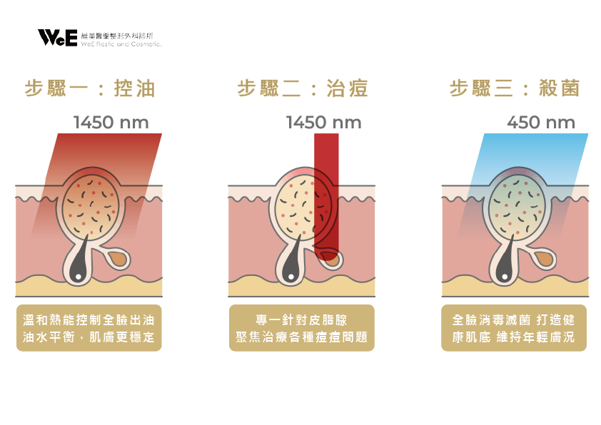 CAPRI藍雷射15分鐘3步驟