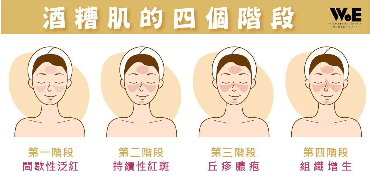 酒糟性肌膚-四個階段